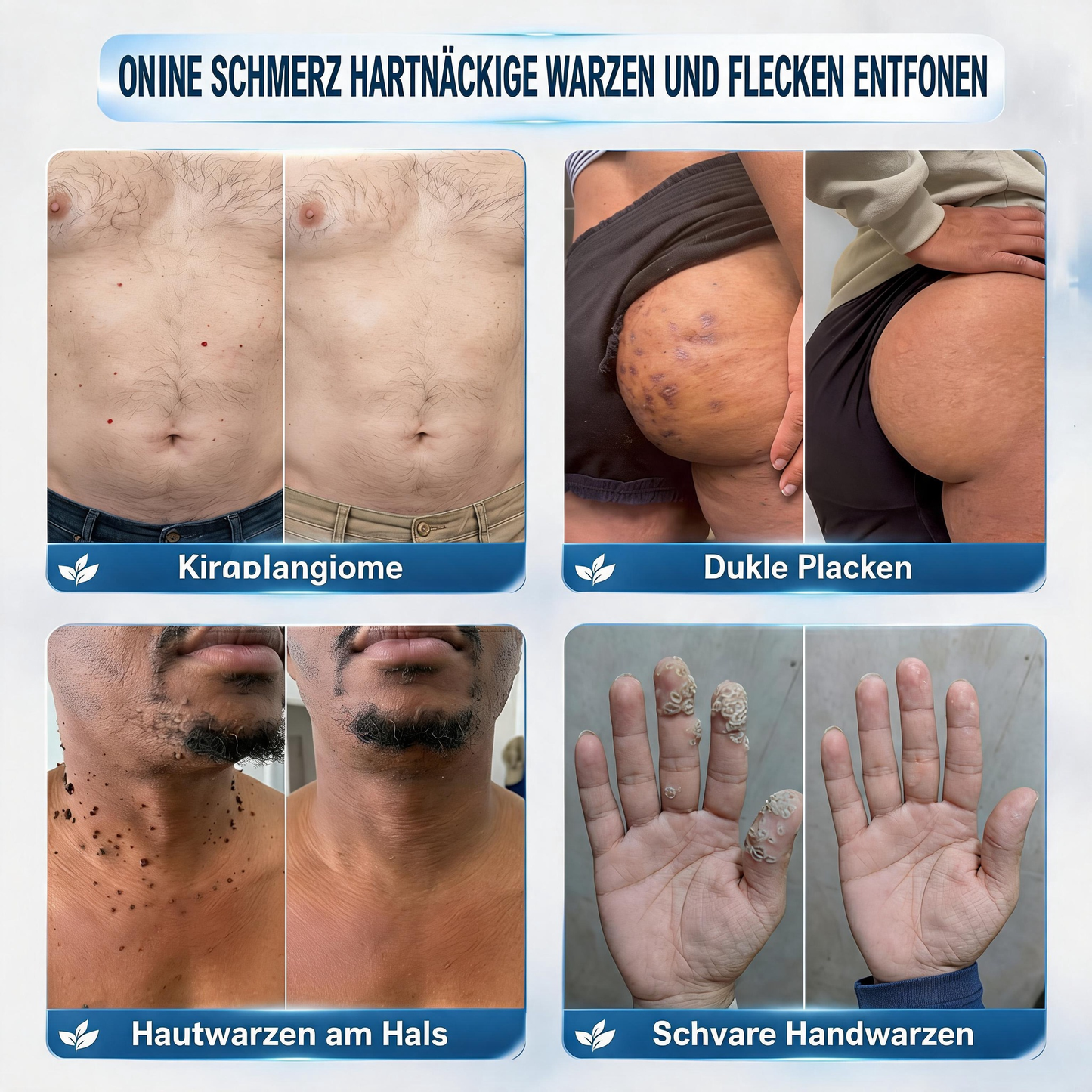 Natravor® 𝟕-𝐓𝐚𝐠𝐞 𝐇𝐚𝐮𝐭𝐚𝐧𝐡ä𝐧𝐠𝐬𝐞𝐥- & 𝐅𝐥𝐞𝐜𝐤𝐞𝐧-𝐄𝐧𝐭𝐟𝐞𝐫𝐧𝐮𝐧𝐠𝐬𝐜𝐫𝐞𝐦𝐞 (𝐒𝐜𝐡𝐦𝐞𝐫𝐳𝐟𝐫𝐞𝐢𝐞 𝐅𝐨𝐫𝐦𝐞𝐥 – 𝐨𝐡𝐧𝐞 𝐍𝐚𝐫𝐛𝐞𝐧) 🎉