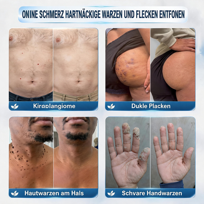 Natravor® 𝟕-𝐓𝐚𝐠𝐞 𝐇𝐚𝐮𝐭𝐚𝐧𝐡ä𝐧𝐠𝐬𝐞𝐥- & 𝐅𝐥𝐞𝐜𝐤𝐞𝐧-𝐄𝐧𝐭𝐟𝐞𝐫𝐧𝐮𝐧𝐠𝐬𝐜𝐫𝐞𝐦𝐞 (𝐒𝐜𝐡𝐦𝐞𝐫𝐳𝐟𝐫𝐞𝐢𝐞 𝐅𝐨𝐫𝐦𝐞𝐥 – 𝐨𝐡𝐧𝐞 𝐍𝐚𝐫𝐛𝐞𝐧) 🎉