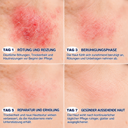 Natravor® 7-Tage Hauterneuerungs- & Reparaturcreme — Beruhigt Juckreiz und unterstützt die Hautregeneration (Sanfte, schmerzfreie Hautpflegeformel) 💎